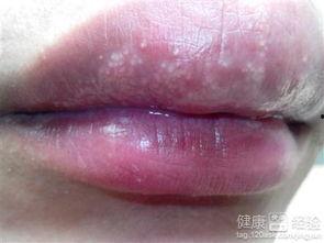 吃蜜瓜嘴角痒,嘴角痒痒的甜蜜体验